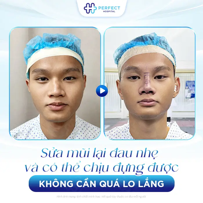 Sửa Lại Mũi Đã Nâng Có Đau Không? Khi Nào Nên Thực Hiện