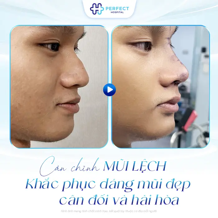 Sửa Lại Mũi Đã Nâng Có Đau Không? Khi Nào Nên Thực Hiện