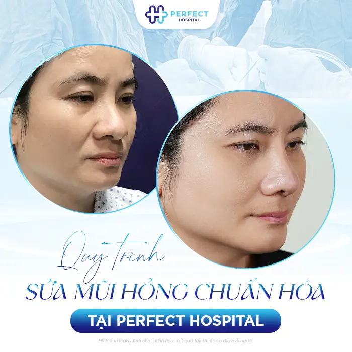 Sửa Lại Mũi Đã Nâng Có Đau Không? Khi Nào Nên Thực Hiện