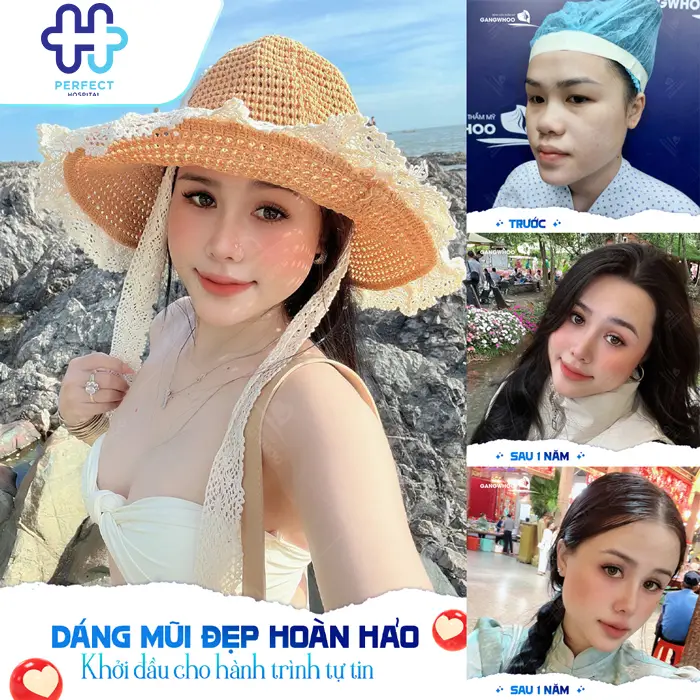 Sụn Nâng Mũi 3D Hàn Quốc Là Gì? Có Tốt Và An Toàn Không