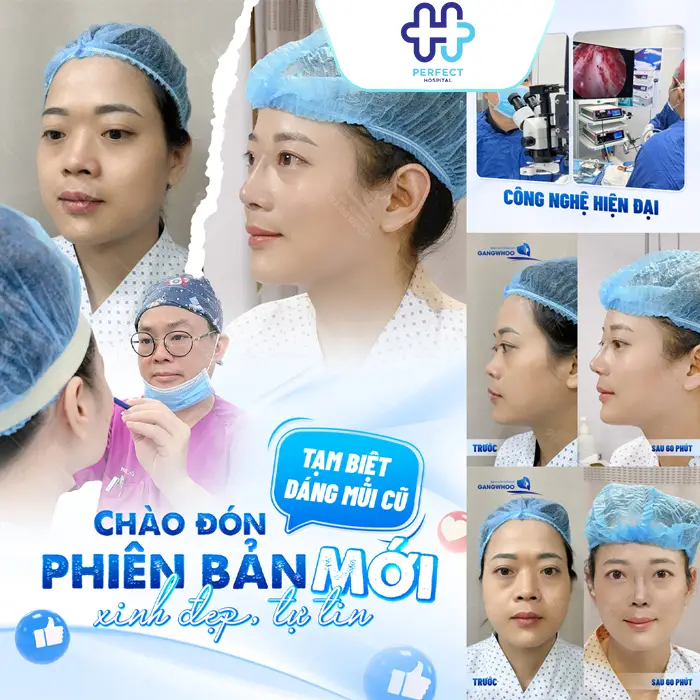 Sụn Nâng Mũi 3D Hàn Quốc Là Gì? Có Tốt Và An Toàn Không