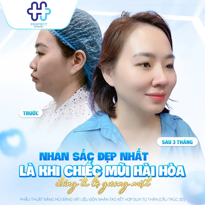 Sụn Nâng Mũi 3D Hàn Quốc Là Gì? Có Tốt Và An Toàn Không