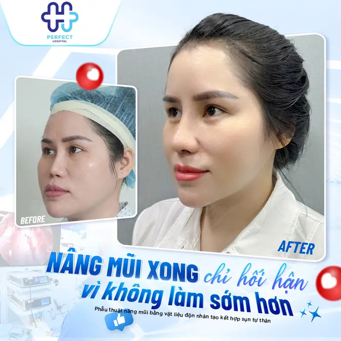 Sụn Nâng Mũi Giá Rẻ Có An Toàn Không? Cập Nhật Giá Mới Nhất