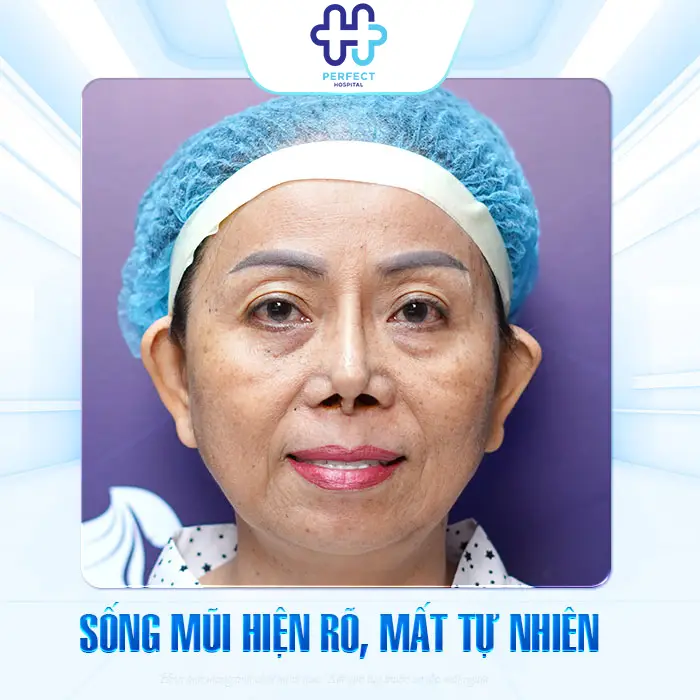 Sụn Nâng Mũi Giá Rẻ Có An Toàn Không? Cập Nhật Giá Mới Nhất