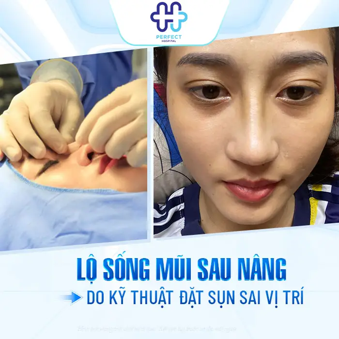 Sụn Nâng Mũi Giá Rẻ Có An Toàn Không? Cập Nhật Giá Mới Nhất