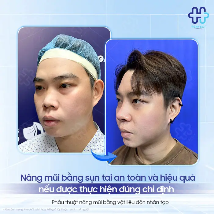 Tác Hại Của Nâng Mũi Bằng Sụn Tai: Có Đáng Lo Không?