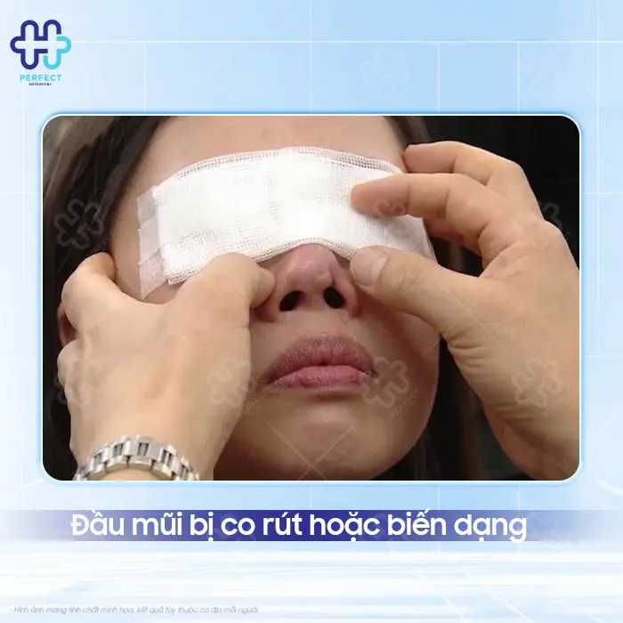 Tác Hại Của Nâng Mũi Bằng Sụn Tai: Có Đáng Lo Không?