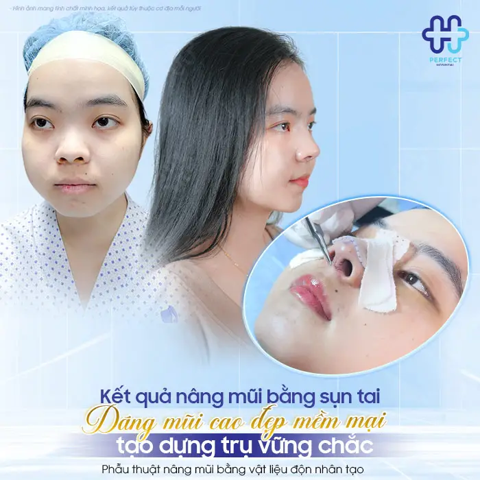 Tác Hại Của Nâng Mũi Bằng Sụn Tai: Có Đáng Lo Không?