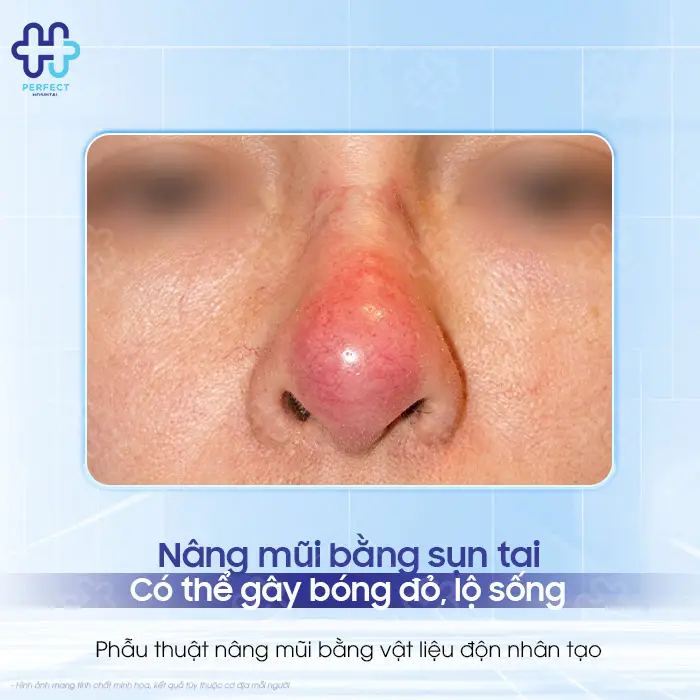 Tác Hại Của Nâng Mũi Bằng Sụn Tai: Có Đáng Lo Không?
