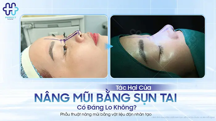 Tác Hại Của Nâng Mũi Bằng Sụn Tai: Có Đáng Lo Không?