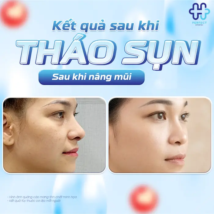 Tháo Sụn Sau Khi Nâng Mũi Có Nguy Hiểm Không Và Khi Nào Nên Thực Hiện
