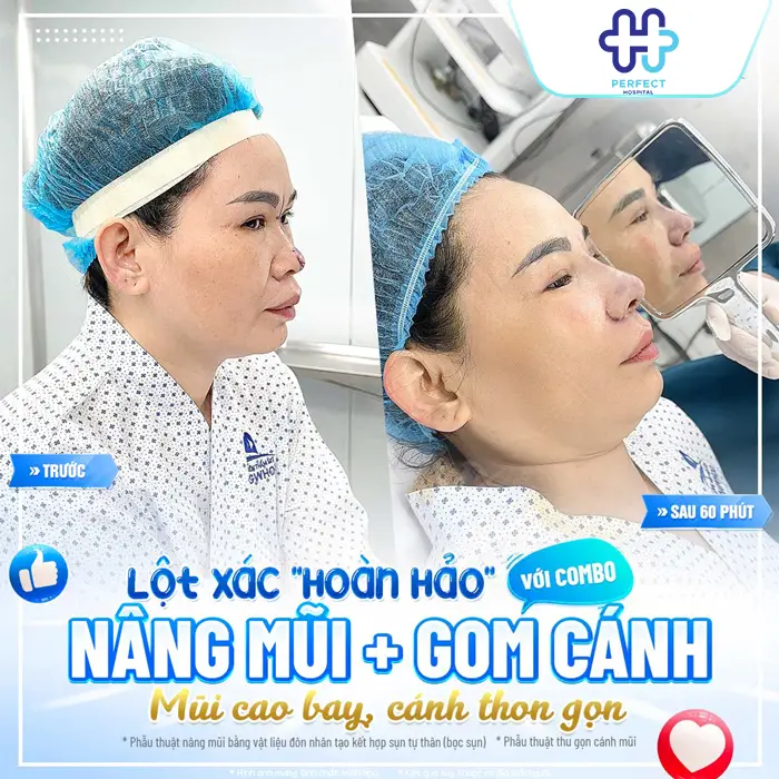 Thu Gọn Cánh Mũi Và Nâng Mũi Có Nên Làm Chung Không?