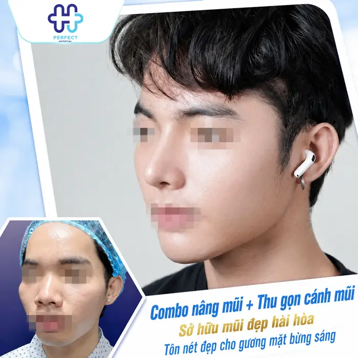 Thu Gọn Cánh Mũi Và Nâng Mũi Có Nên Làm Chung Không?