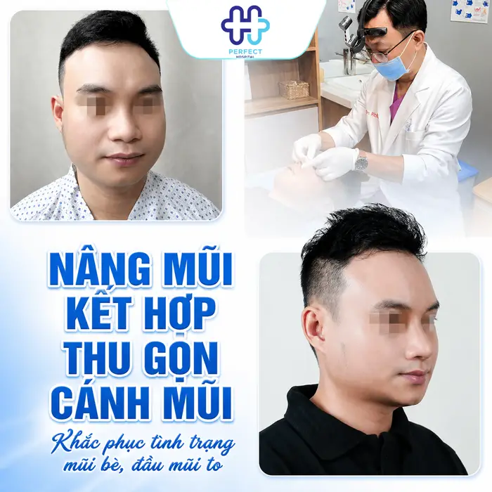 Thu Gọn Cánh Mũi Và Nâng Mũi Có Nên Làm Chung Không?