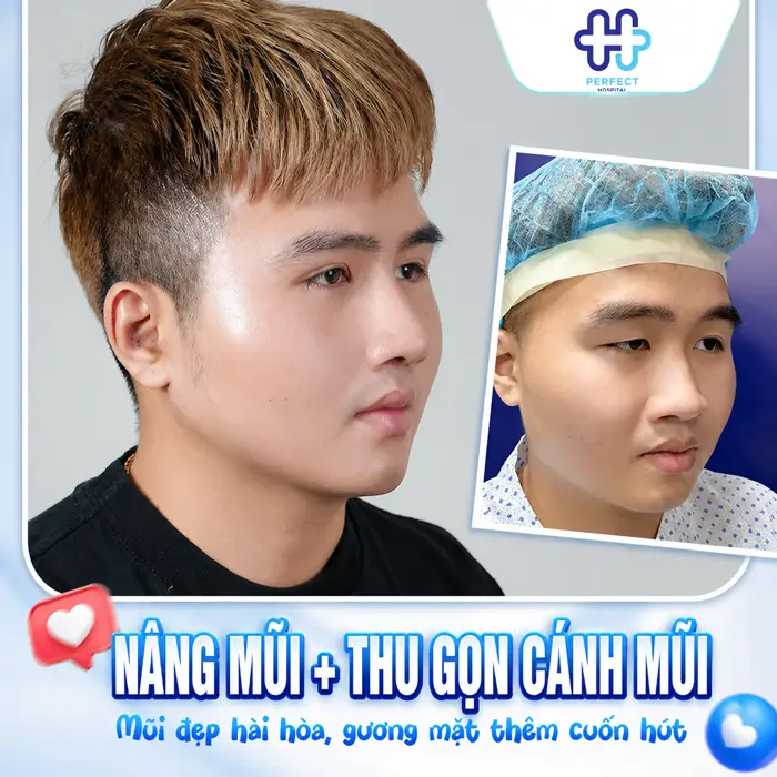 Thu Gọn Cánh Mũi Và Nâng Mũi Có Nên Làm Chung Không?