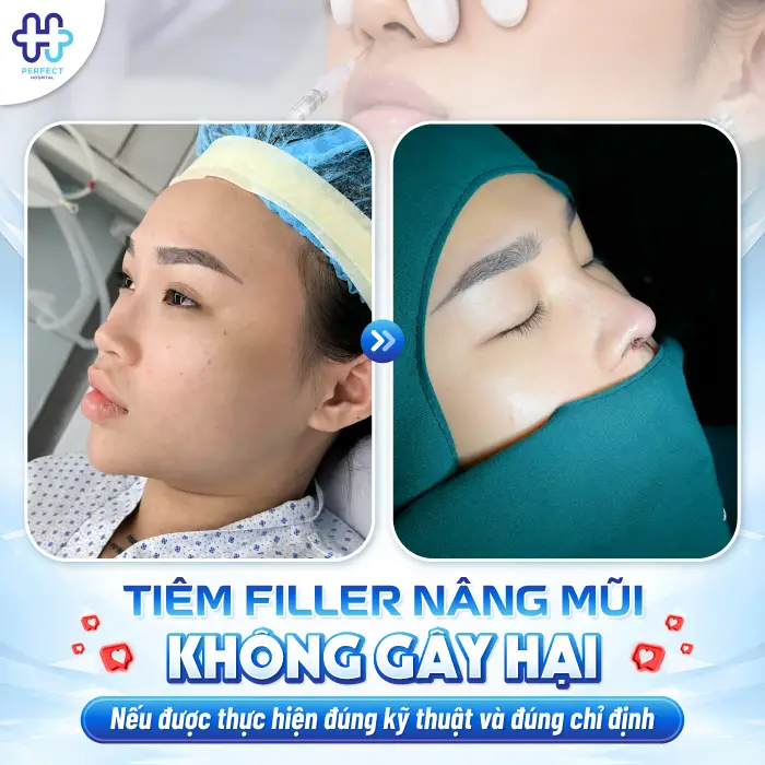 Tiêm Nâng Mũi Có Hại Không? Bác Sĩ Giải Đáp Về Độ An Toàn