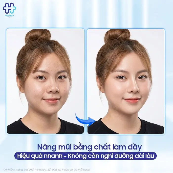 Tiêm nâng mũi bằng filler là gì? Có nên lựa chọn phương pháp này?