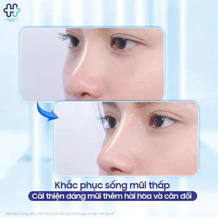 Tiêm nâng mũi bằng filler là gì? Có nên lựa chọn phương pháp này?