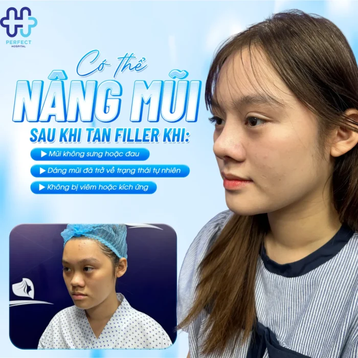 Tiêm Tan Filler Bao Lâu Thì Nâng Mũi Được Và Thời Điểm An Toàn