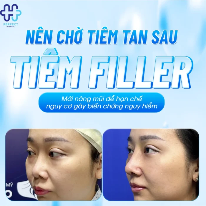 Tiêm Tan Filler Bao Lâu Thì Nâng Mũi Được Và Thời Điểm An Toàn