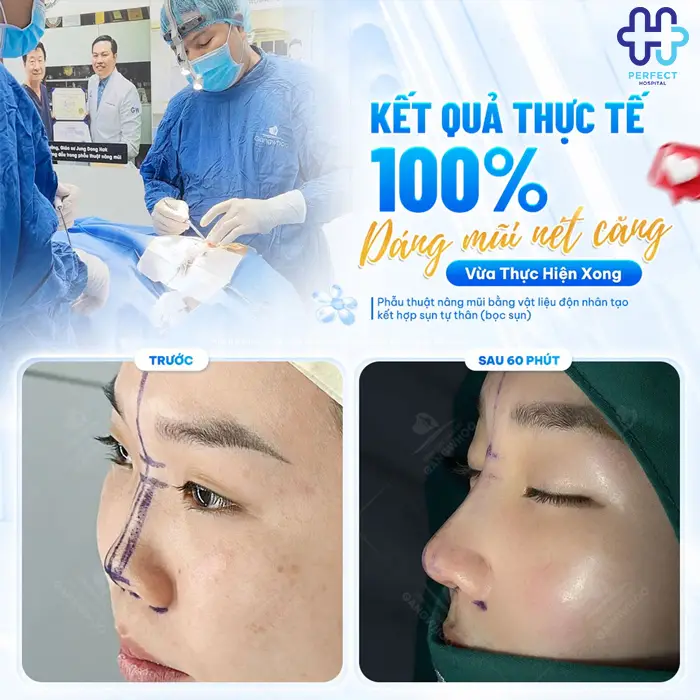 Tiêm Tan Filler Bao Lâu Thì Nâng Mũi Được Và Thời Điểm An Toàn