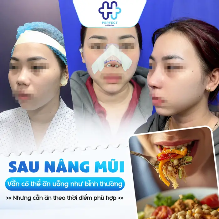 Trước Khi Nâng Mũi Nên Ăn Gì? Những Lưu Ý Trước Khi Nâng Mũi