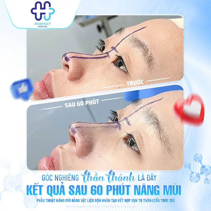 Trước và sau nâng mũi: Sự thay đổi thực tế bạn cần biết