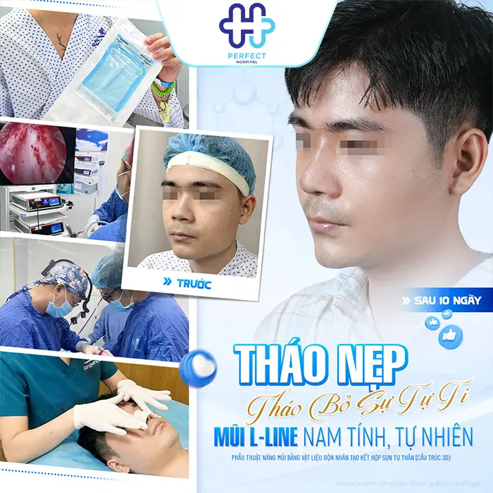 Trước và sau nâng mũi: Sự thay đổi thực tế bạn cần biết