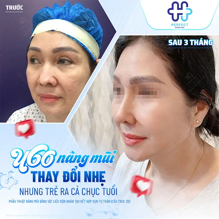 Trước và sau nâng mũi: Sự thay đổi thực tế bạn cần biết