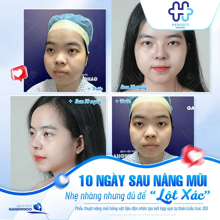 Trước và sau nâng mũi: Sự thay đổi thực tế bạn cần biết