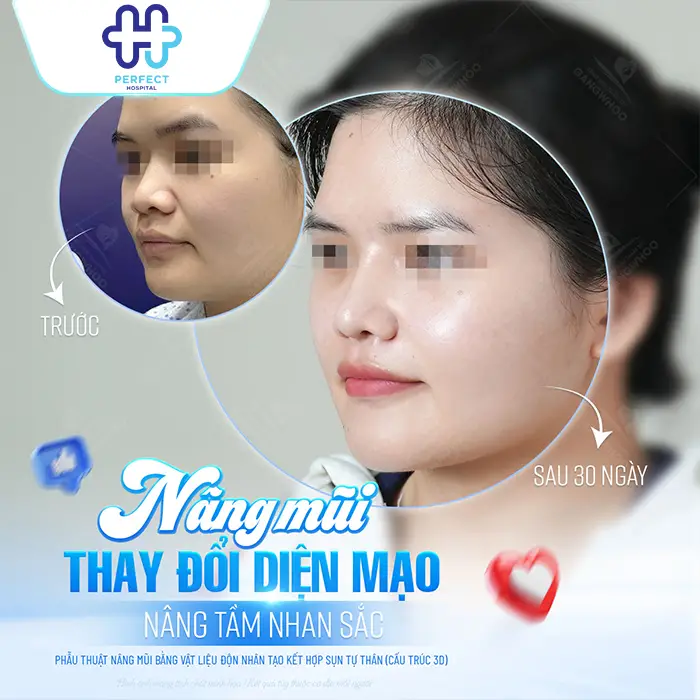 Trước và sau nâng mũi: Sự thay đổi thực tế bạn cần biết