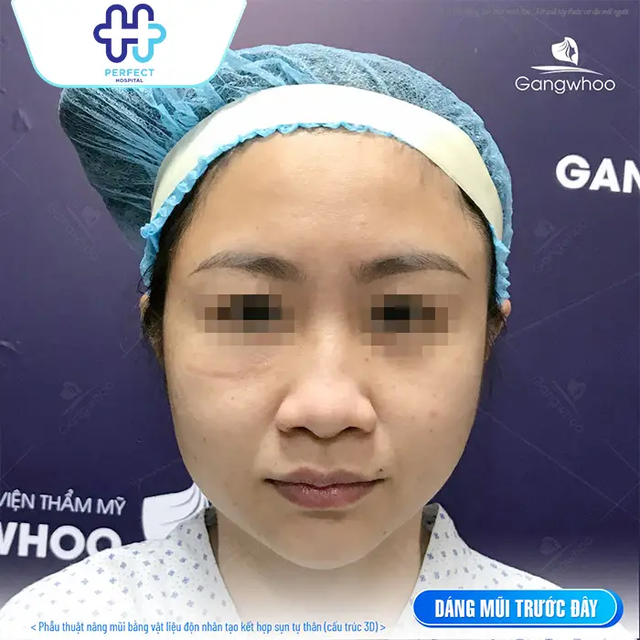 Trước và sau nâng mũi: Sự thay đổi thực tế bạn cần biết