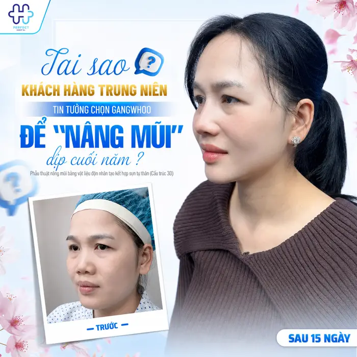 50 Tuổi Có Nên Nâng Mũi Không? Góc Nhìn Từ Chuyên Gia Thẩm Mỹ