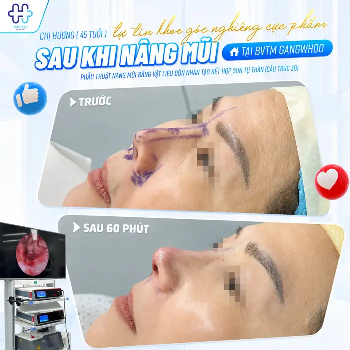 50 Tuổi Có Nên Nâng Mũi Không? Góc Nhìn Từ Chuyên Gia Thẩm Mỹ