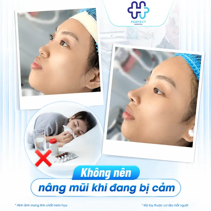 Bị Cảm Có Nâng Mũi Được Không? Khi Nào Nên Trì Hoãn Phẫu Thuật