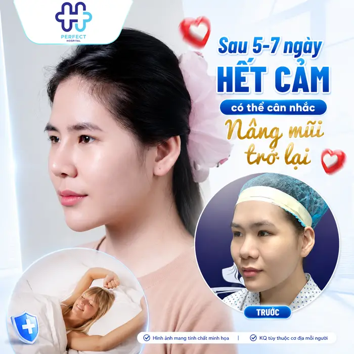 Bị Cảm Có Nâng Mũi Được Không? Khi Nào Nên Trì Hoãn Phẫu Thuật