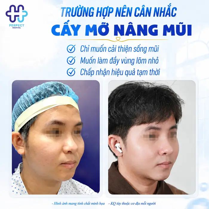 Có Nên Nâng Mũi Bằng Mỡ Tự Thân Không? Sự Thật Cần Biết