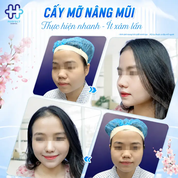 Có Nên Nâng Mũi Bằng Mỡ Tự Thân Không? Sự Thật Cần Biết