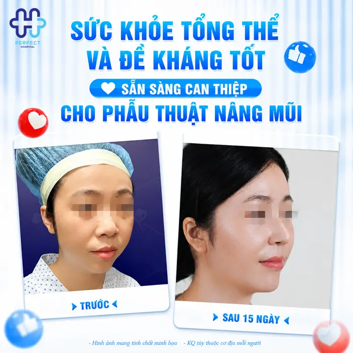 Có Nên Nâng Mũi Sau Khi Nâng Ngực Không? Giải Đáp Từ Chuyên Gia