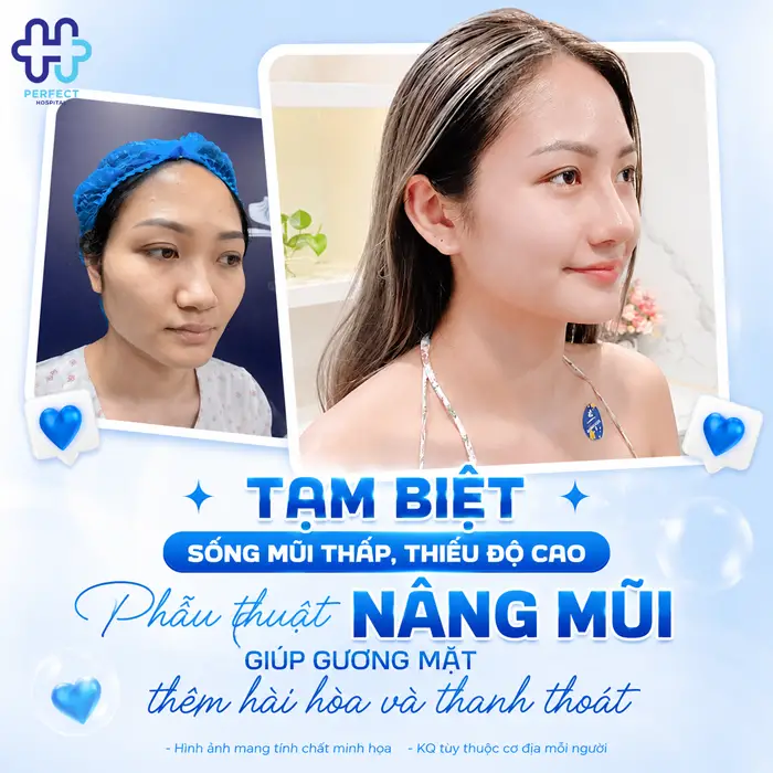 Gò Má Cao Có Nên Nâng Mũi Không? Phân Tích Từ Góc Nhìn Thẩm Mỹ
