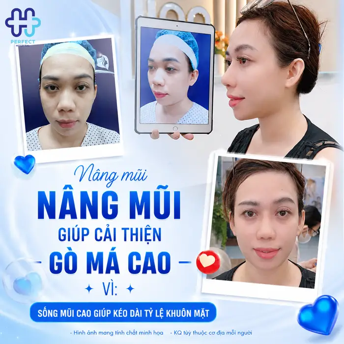 Gò Má Cao Có Nên Nâng Mũi Không? Phân Tích Từ Góc Nhìn Thẩm Mỹ