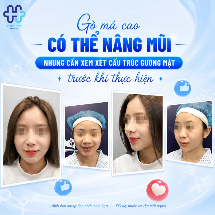 Gò Má Cao Có Nên Nâng Mũi Không? Phân Tích Từ Góc Nhìn Thẩm Mỹ