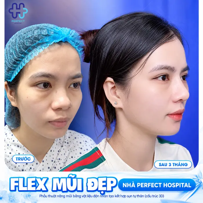 Mặt Hơi Dài Thì Nâng Mũi Dáng Nào Đẹp, Cân Đối Tự Nhiên?