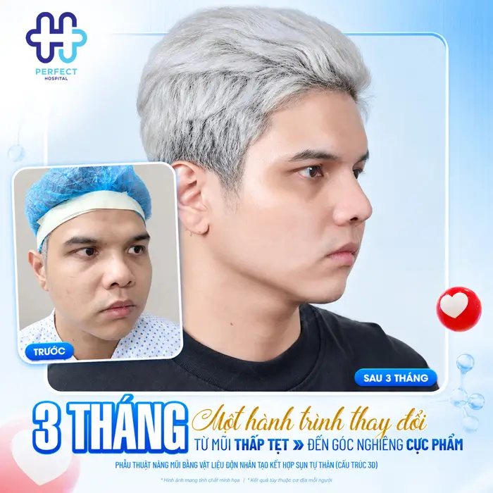 Mặt Trái Xoan Nâng Mũi Kiểu Nào Đẹp Tự Nhiên, Chuẩn Tỷ Lệ?
