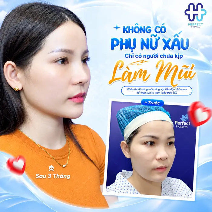 Mặt Trái Xoan Nâng Mũi Kiểu Nào Đẹp Tự Nhiên, Chuẩn Tỷ Lệ?