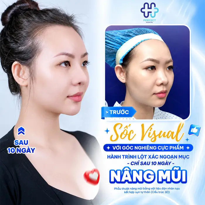 Mặt Trái Xoan Nâng Mũi Kiểu Nào Đẹp Tự Nhiên, Chuẩn Tỷ Lệ?