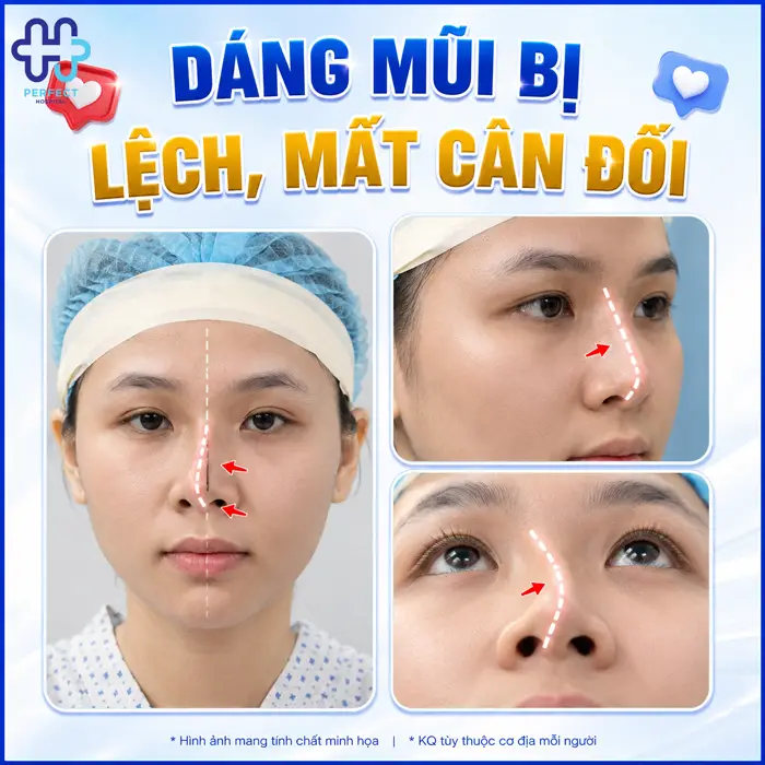 Mũi Bị Lung Lay Sau Nâng Mũi Có Sao Không? Nguyên Nhân & Cách Xử Lý