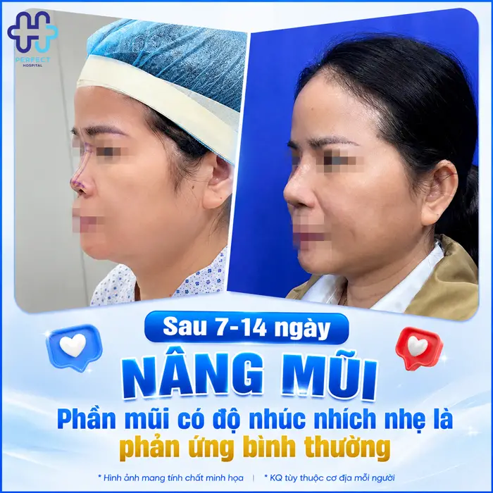 Mũi Bị Lung Lay Sau Nâng Mũi Có Sao Không? Nguyên Nhân & Cách Xử Lý