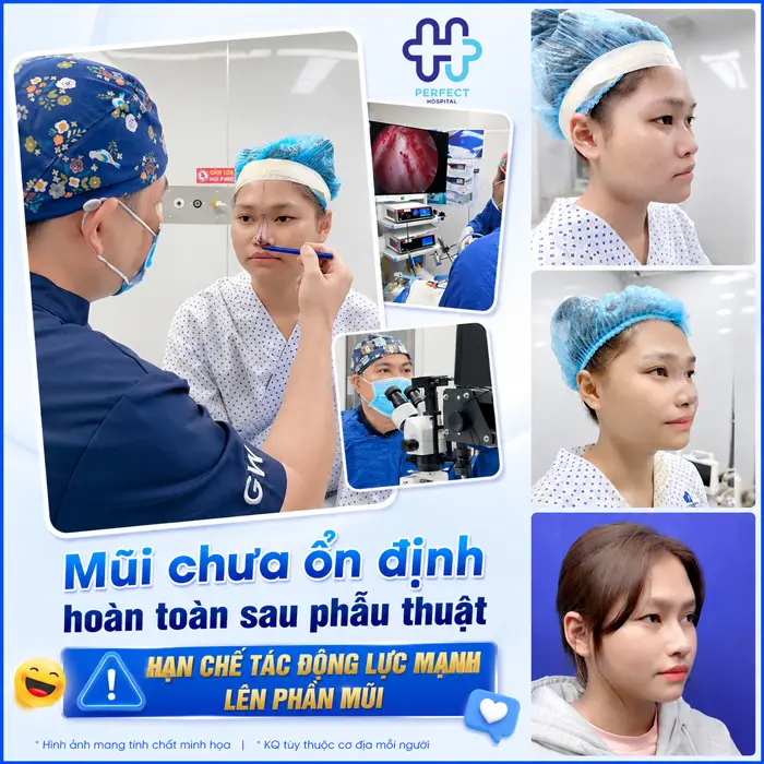 Mũi Bị Lung Lay Sau Nâng Mũi Có Sao Không? Nguyên Nhân & Cách Xử Lý
