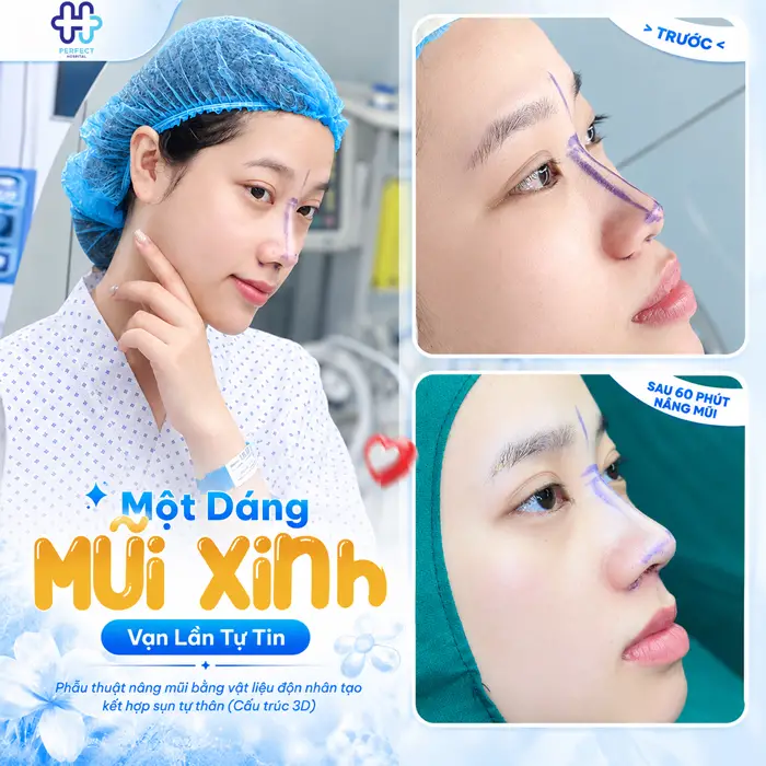 Mũi Tẹt Và Hếch Nên Nâng Kiểu Nào Để Đẹp Tự Nhiên, Hài Hòa?
